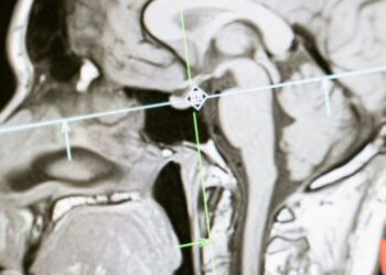 Brain Injury Lawsuit Compensation, Claims & Rights