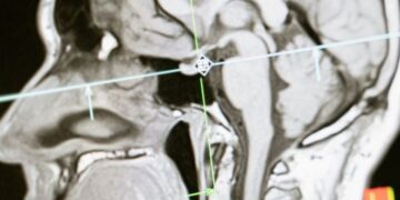 Brain Injury Lawsuit Compensation, Claims & Rights